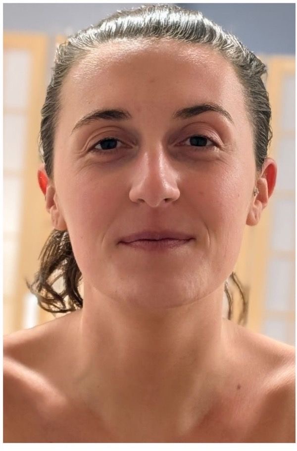 Before: Marie A, before facial lymphatic drainage massage